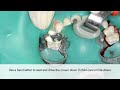 restoring an upper primary molar with a ssc voiceover us