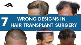 Best Hair Transplant In India | Best, Cost, Results Hair Transplant In India