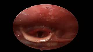 Severe GERD I Acute Laryngitis I Foreign body sensation throat