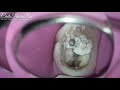 one visit endodontic perawatan akar gigi endodontist spesialis konservasi gigi one curve micro mega