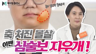 심부볼 심술보 불독살 리프팅, 결국 다 같은 부위라고?