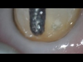 Porcelain veneer margin preparation