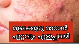 മുഖക്കുരു മാറാൻ  ഏറ്റവും എളുപ്പവഴി|How to get rid off pimples naturally