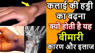 कलाई की हड्डी बढ़ने के कारण और इलाज | Wrist Ganglion Cyst Hindi