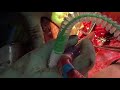 hepatic vein isolation