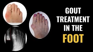 Gout Treatment in the Foot