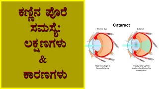 Cataracts: Symptoms and causes | Vijay Karnataka