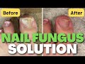 Natural Nail Fungus Solution (See Results in 2 WEEKS)