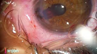 Corneal Laceration Repair