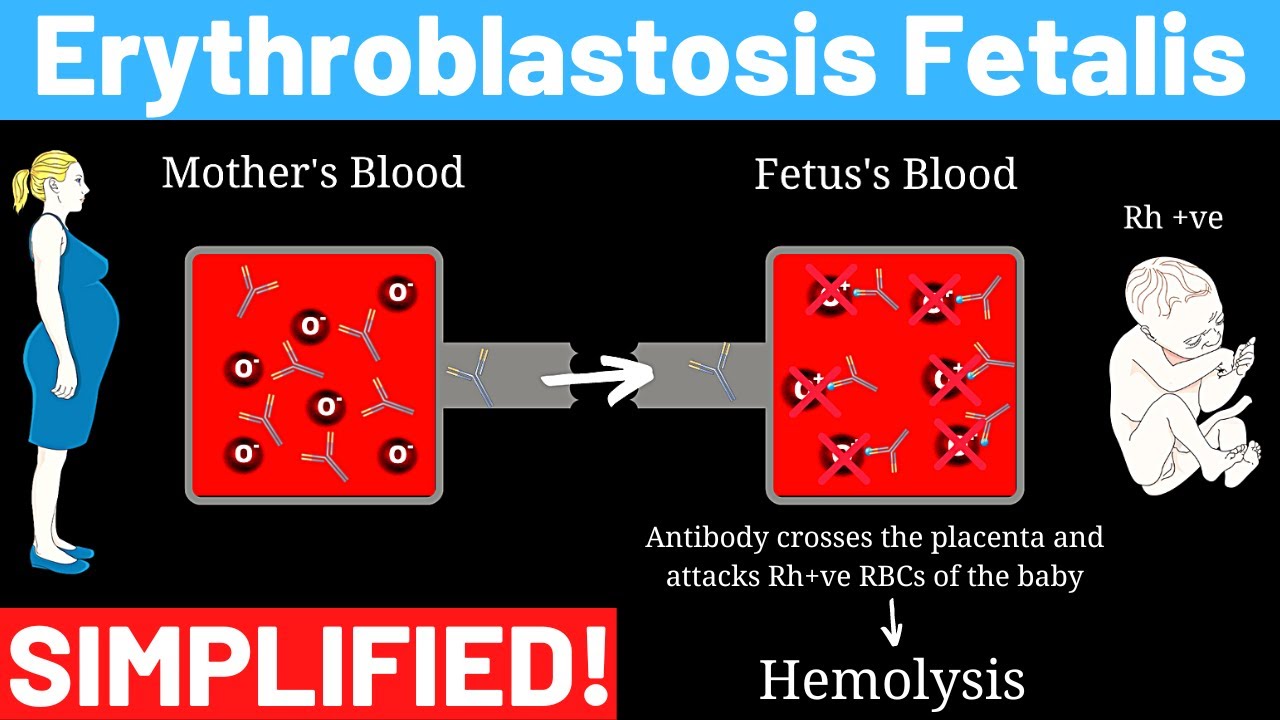 What Is Rh Incompatibility In Pregnancy? - Erythroblastosis Fetalis ...