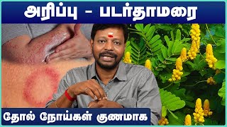 Psoriasis - Diagnosis and treatment | படர்தாமரை முற்றிலும் குணமாக | Mayan Senthil | Cosmo Health