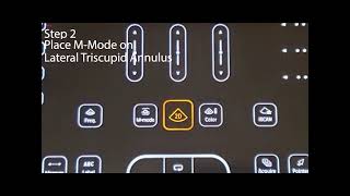 TAPSE (Tricuspid Annular Plane Systolic Excursion)