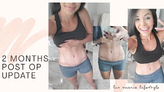 8 Weeks Post-Op Mommy Makeover Plastic Surgery Update!! Close up views! Items linked below :)
