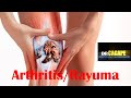 Arthritis/ Rayuma