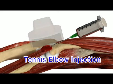 Tennis Elbow Injection Lateral Epicondylitis Treated With Cortisone ...