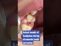 atraumatic tooth extraction