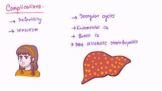 PCOD- Polycystic ovarian disease (Pathogenesis, Clinical features, Diagnosis, Management)
