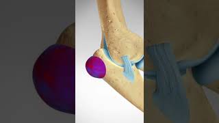 Triceps Tendon Avulsion and Repair #elbowpainrelief #elbowpain