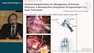 Лапароскопическая хирургия нижней трети мочеточника