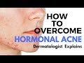 Skin Care Tips- Treating HORMONAL ACNE