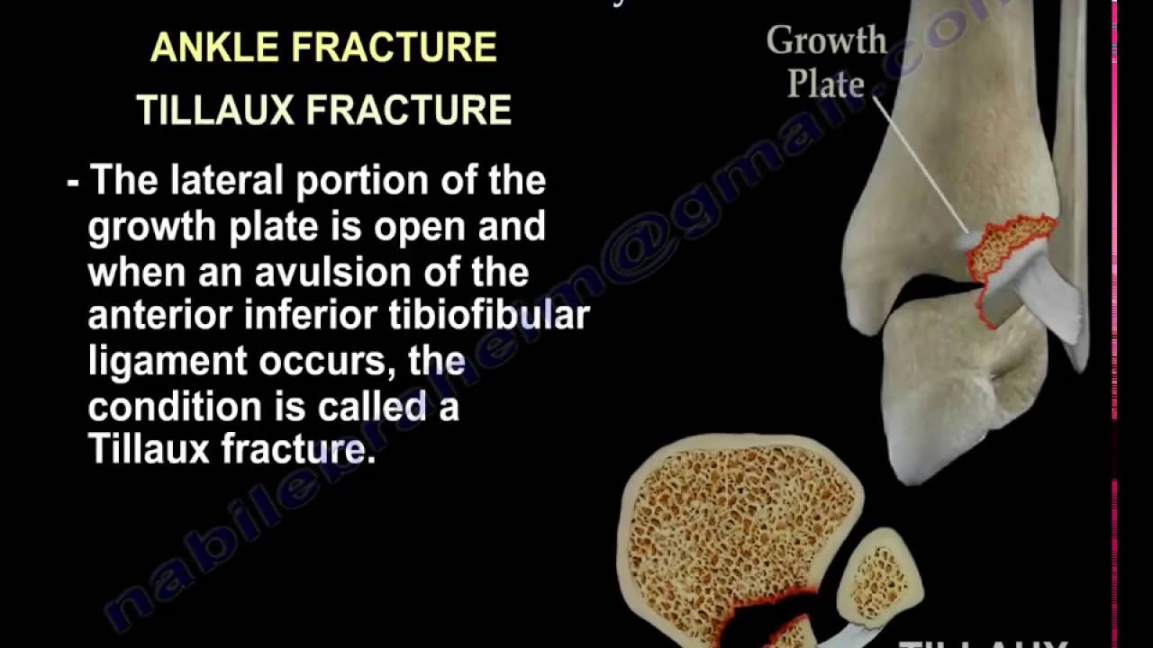 Pediatric Fractures Of The Lower Extremity Review - Everything You Need ...