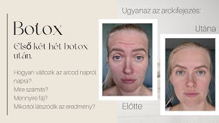 Botox - Hogyan változik az arcod napról napra, első két hét botox után | Suzy Dan