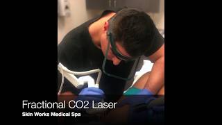 Fractional CO2 Laser for Stretch Mark Removal  in Torrance \u0026 South Bay Los Angeles Ca