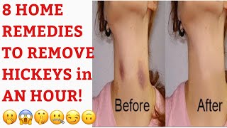8 HOME REMEDIES TO REMOVE HICKEYS or LOVE BITES in LESS THAN AN HOUR! D&N Medical Series