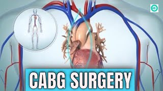 CABG (coronary artery bypass graft): Open Heart Surgery