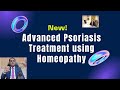 New Advance Psoriasis Treatment using Homeopathy