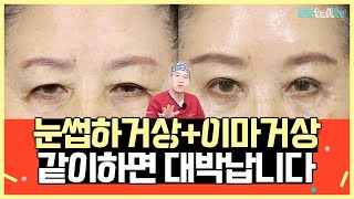 [눈썹하거상+이마거상] 같이하면 대박납니다