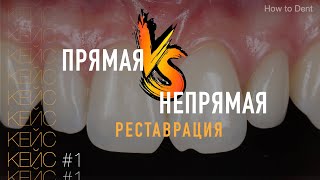 Прямая и непрямая реставрация передних зубов. Как сочетать их вместе? / Кейс #1