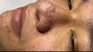 luxury daily acne treatment  blackheads removal with Nasa spa #123 2023