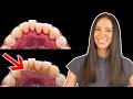 How To Remove Difficult Calculus as a Dental Hygienist