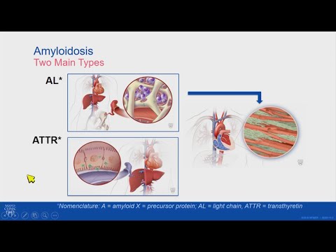 What is the treatment for cardiac amyloidosis?