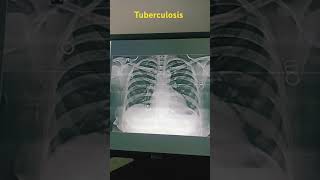 Xray Chest pa tuberculosis hiller are prominent bhoth lung filde