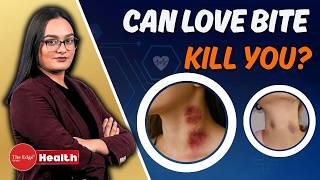 Har Din Sehat: Can a Hickey K*ll You? The Shocking Truth Behind Love Bites and Stroke Risks