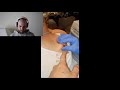 huge cyst explosion on the back of this man ! asmr