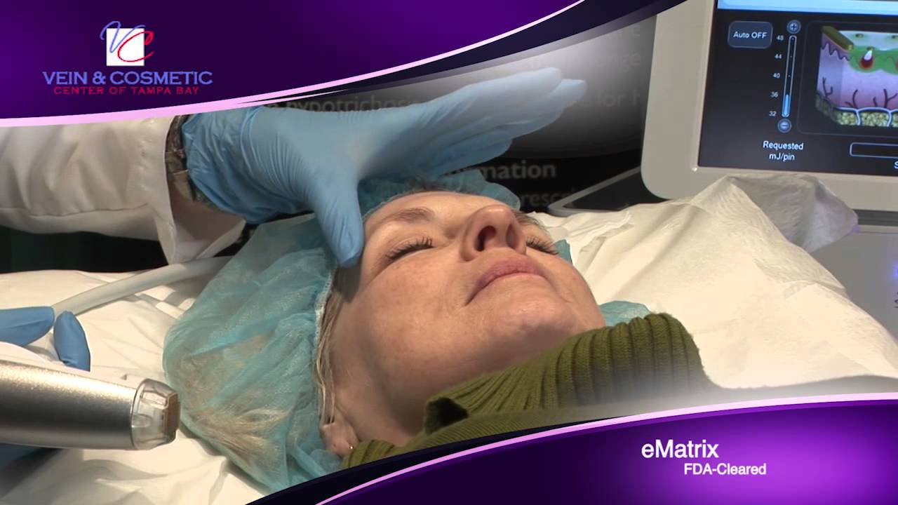 Ematrix Laser Treatment Youtube