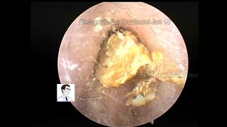 Ear wax removal, Treatment of cerumen embolism