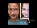 designer rhinoplasty tm by dr. kassir