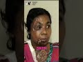 The Horrifying Truth About Acid Attacks in Bangladesh