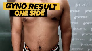 Unilateral Gynecomastia Result After 8 Months