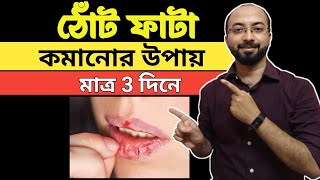 শীতকালে ঠোঁট ফাটা কেন | ঠোঁট ফাটার কারণ কি | ঠোঁট ফাটার ক্রিম | ঠোঁট ফাটা দূর করার ঘরোয়া উপায়