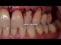 treatment of advanced periodontal gum disease.