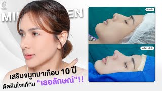 [ศัลยกรรมจมูกครบ 4 เดือน] เสริมจมูกมาเกือบ 10 ปี ตัดสินใจมาแก้กับรพ.เลอลักษณ์