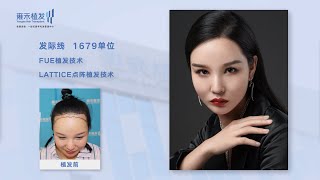 澳門髮際線植髮的效果如何？她植髮術後效果公開曝光！Yonghe hair transplant