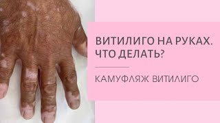 ВИТИЛИГО НА РУКАХ. Камуфляж витилиго на руках