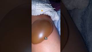 Truth About Blister 😳