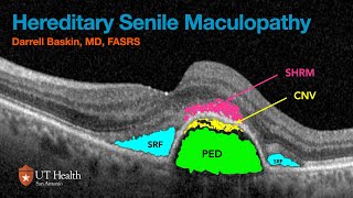 Macular Degeneration (HSM+) 2024